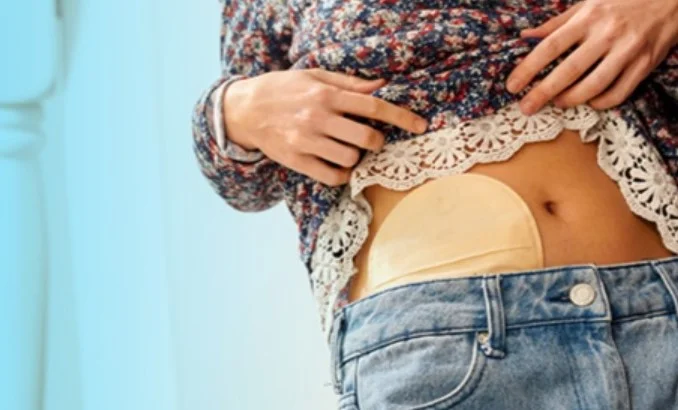 Educational Webinar: Ostomy Mysteries Unveiled
